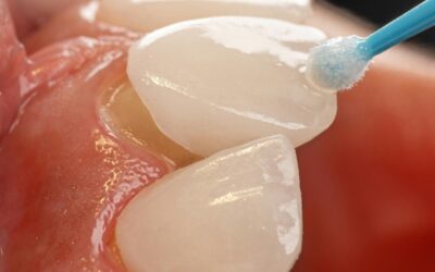 Porcelain Crown Dental Guide: Benefits, Procedure, and a New Smile