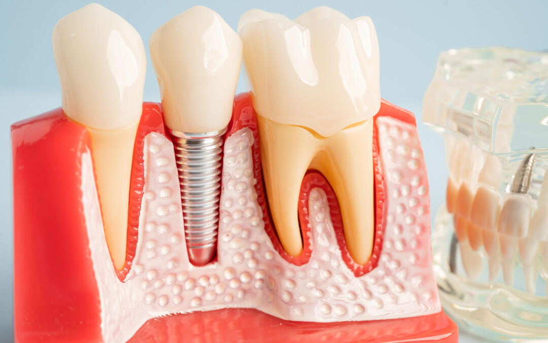 dental implants in rochester ny