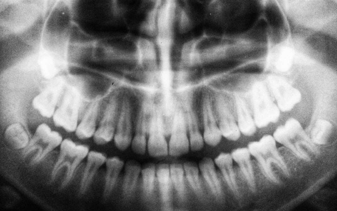 dental implants rochester ny