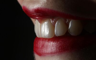 How Long Do Teeth Whitening Results Last in Rochester, NY?