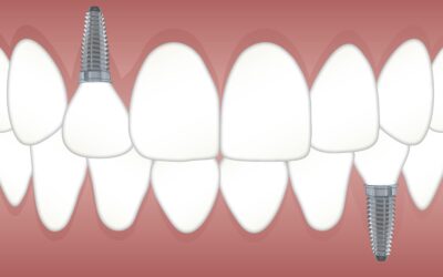 How Much Do Dental Implants in Rochester, NY Cost?